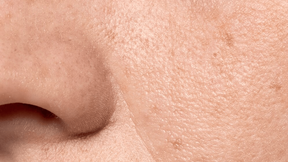 como usar el dermapen. Tratamientos con Dermapen